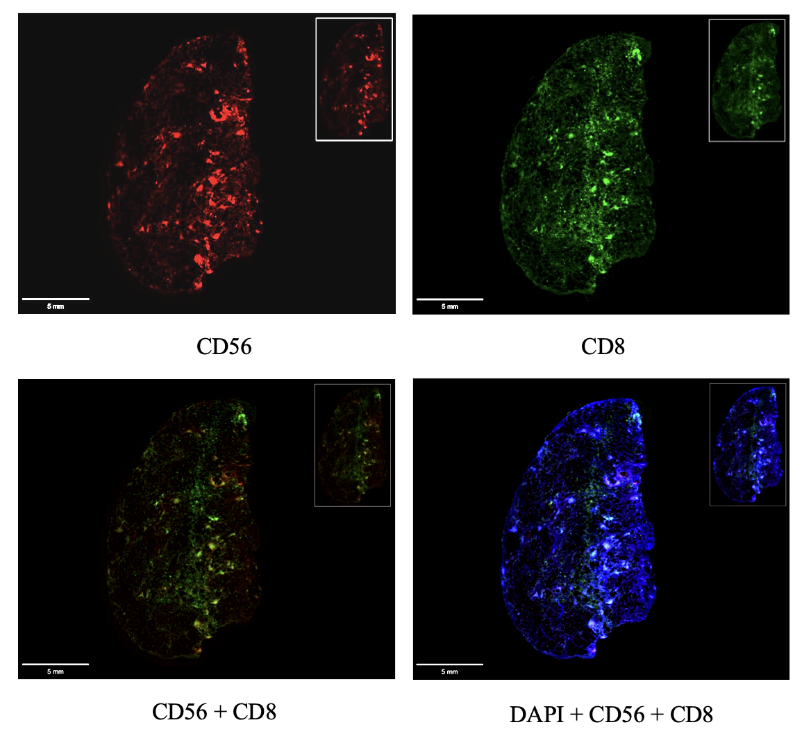 Spatial proteomics lung imaging of CD8+ and CD56+ cell distribution. Scale bar = 5 mm.